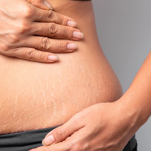 Moroccan pure Argan oil for Skin Repair, Stretch Marks & Healing